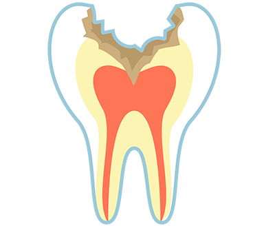 C3:歯の神経に達したむし歯