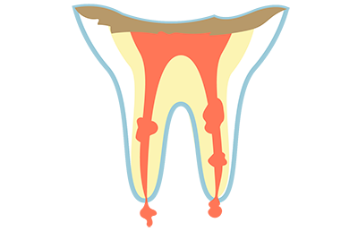 C4:歯根にまで達したむし歯