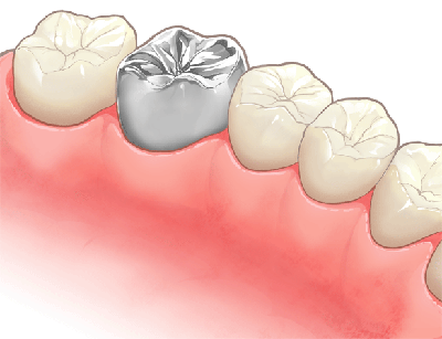 銀歯がもたらす金属アレルギー