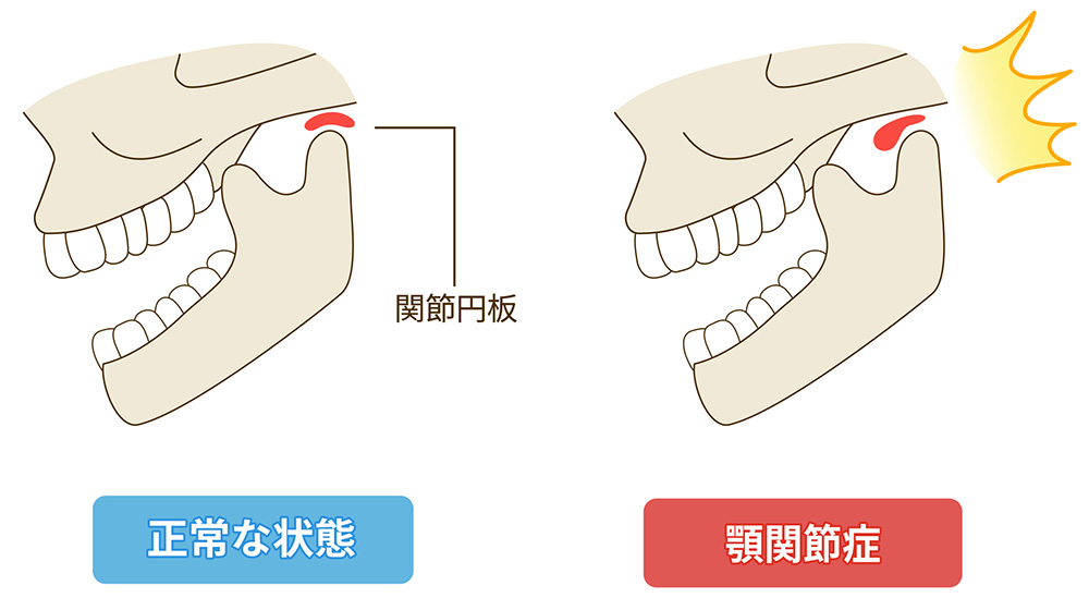 顎関節症