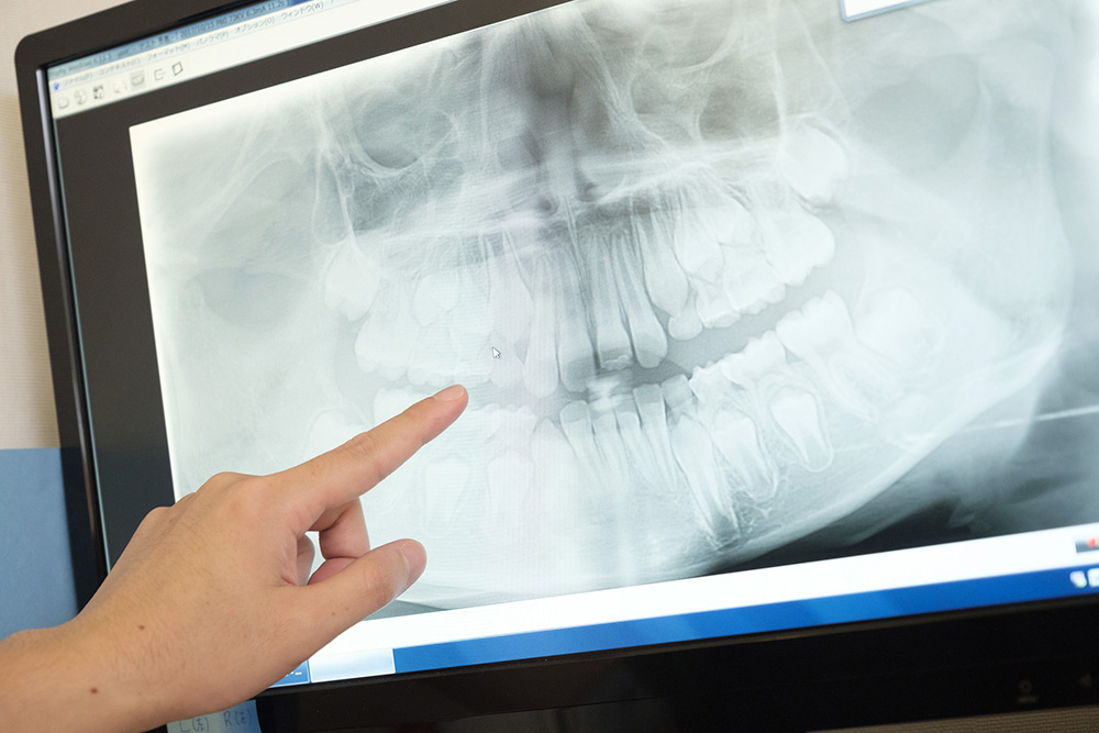 歯科用CTで正確な診断