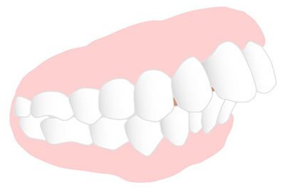 上顎前突（出っ歯）