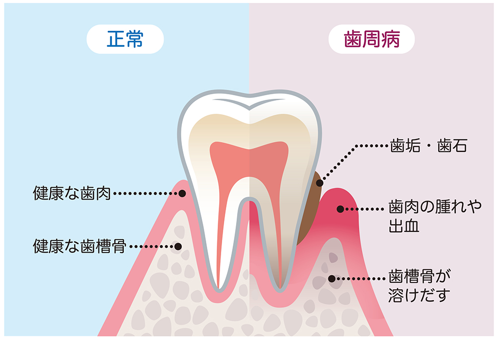 歯周病について