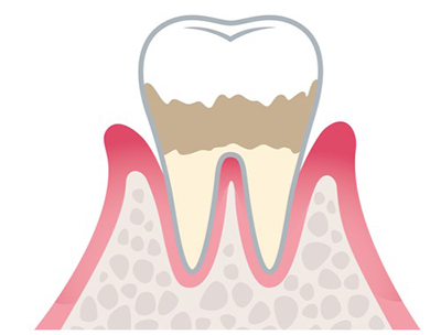 軽度歯周病