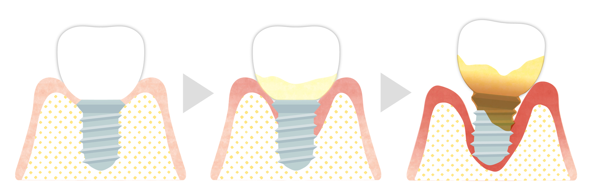 インプラント歯周炎の予防