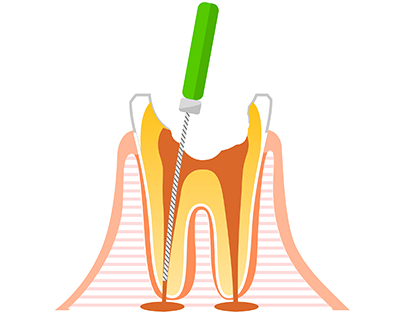 根管治療とは？